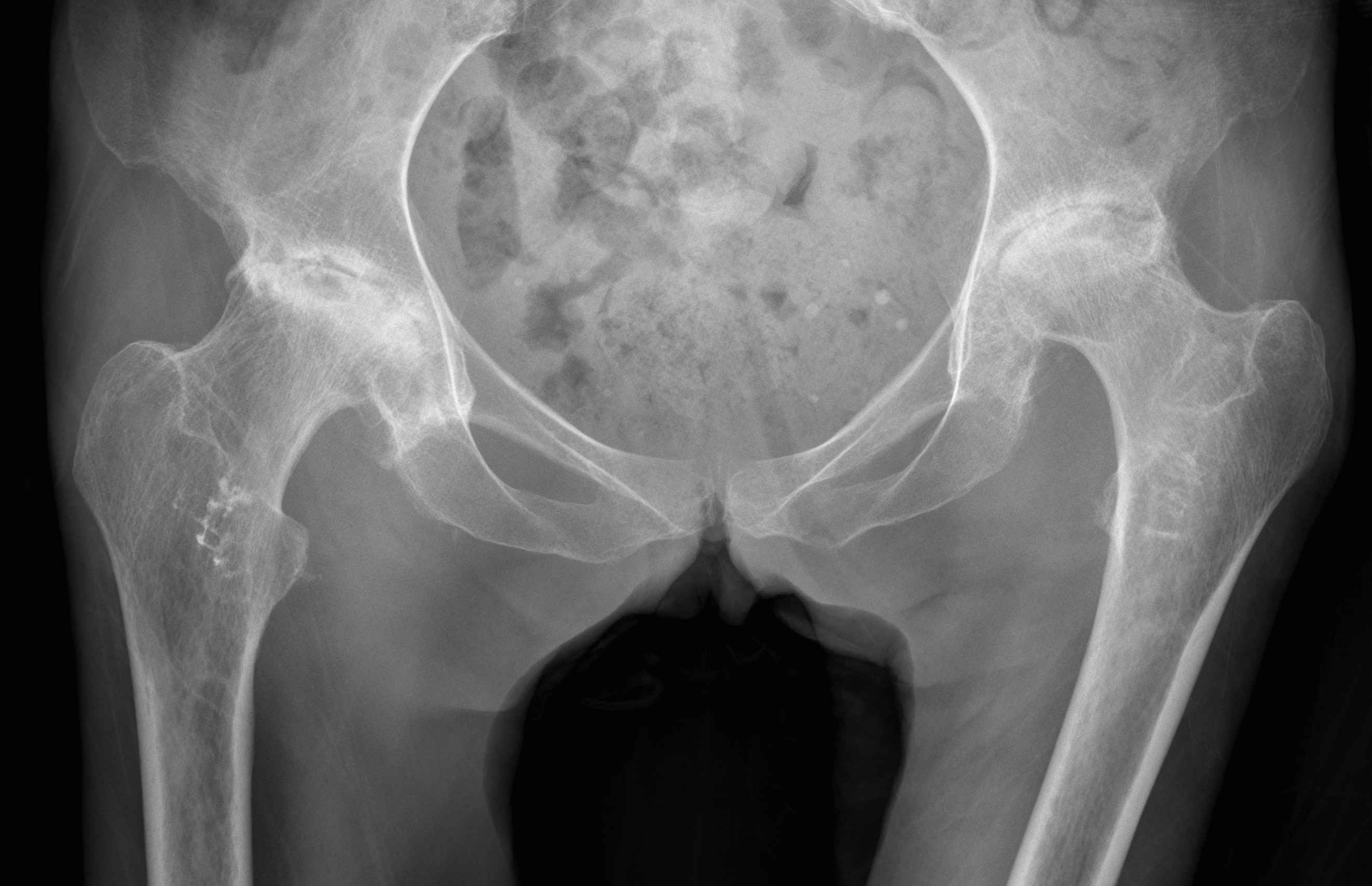 HIp OA Bilateral AVN